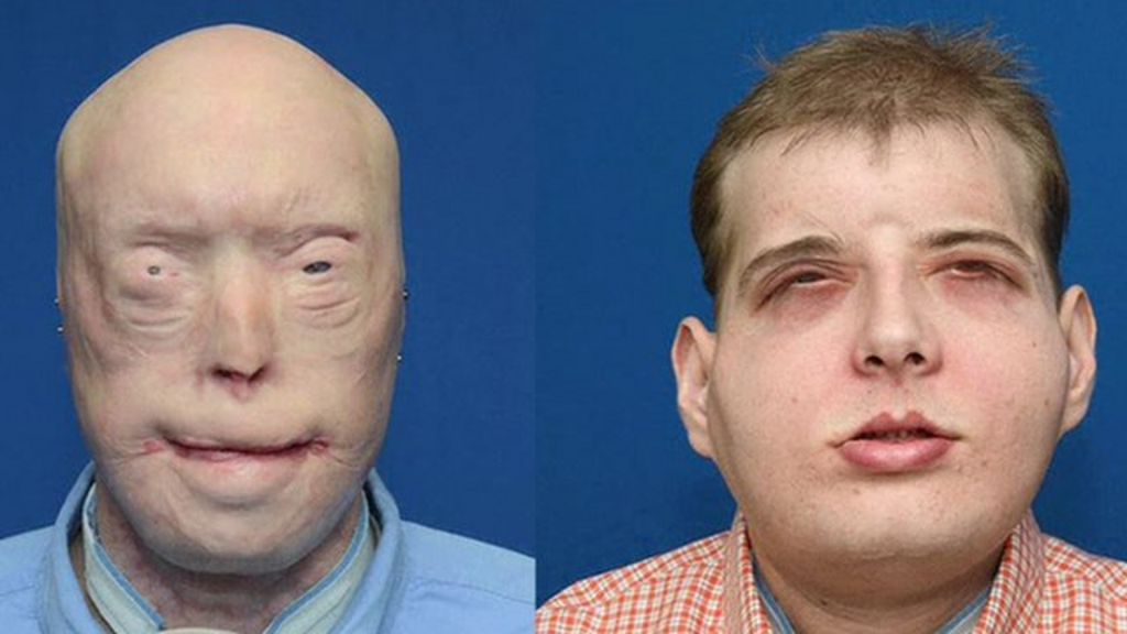 Face transplant before and after picture