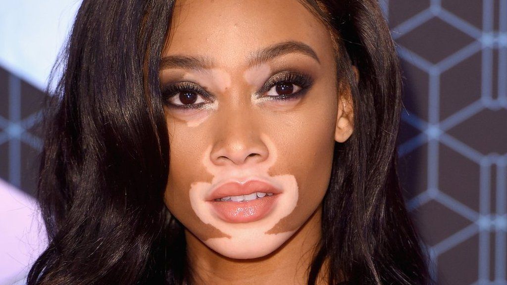 100 Women 2016 Model Winnie Harlow On Confidence And Defiance Bbc News 