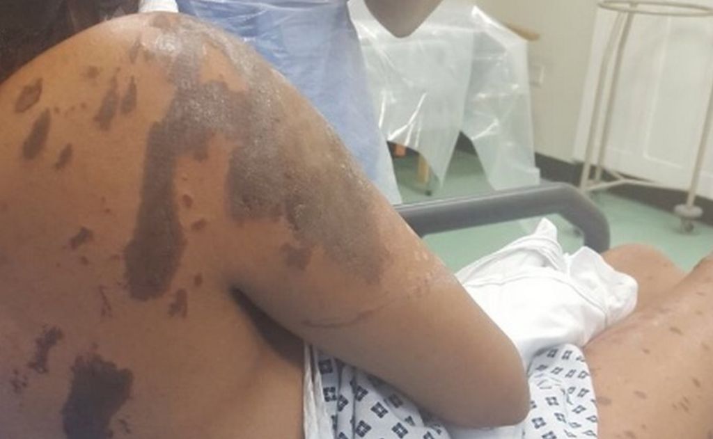 Two have 'life changing' injuries after acid attack