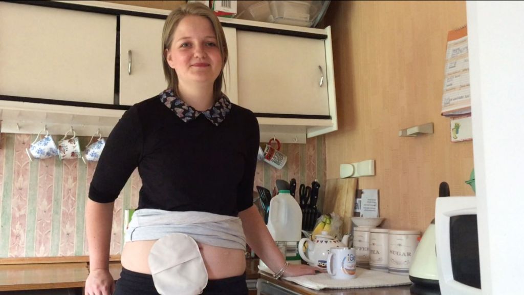 'My stoma bag's given me my life back'