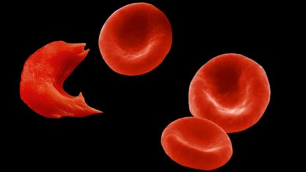 Sickleshaped blood cells 'may kill cancer cells in mice