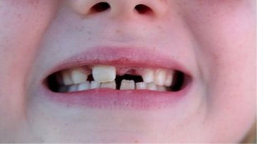 Coconut oil could combat tooth decay BBC News