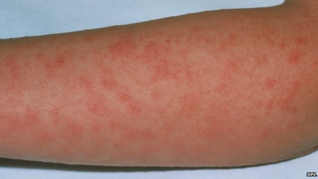 High fever and rash