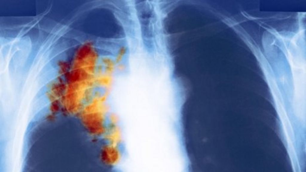 Lung Cancer still Biggest Cancer Killer In Wales Figures Show BBC News