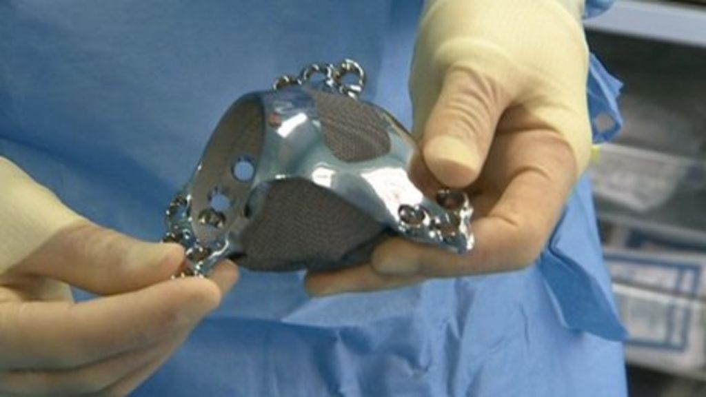 Patient Has 3D-printed Hip Replacement In Southampton - BBC News