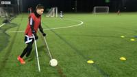 Amputee footballer