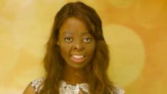 Raiché suffered 70% burns in a house fire at 18 months old