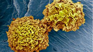 breast cancer cells