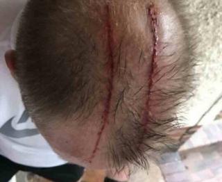 Top of man's head after bird attack