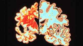 Alzheimer's disease brain compared to normal