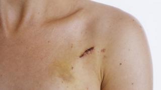 Pacemaker scar