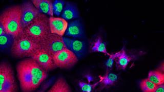 Prostate cancer cells