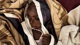 severely malnourished child in Tshikapa
