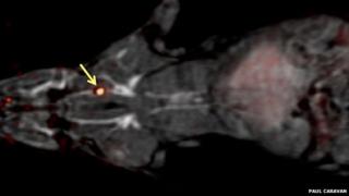 A blood clot highlighted in an MRI scan