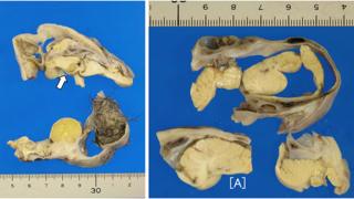 Tumor