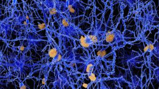 Alzheimer's plaques