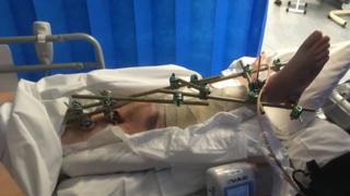 The teenager remains in hospital and faces further surgery
