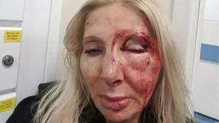 Unnamed victim of Tube attack