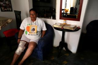 Mujer sentada en un sofá azul con la pierna derecha cubierta de vendajes.
