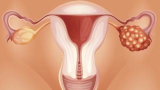 ovary cancer