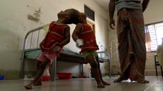 বাবা-মায়ের সাহায্য ছাড়াই হাটতে পারে মাথায় জোড়া লাগানো জমজ শিশু রাবেয়া-রোকেয়া।