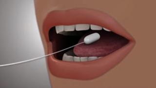 Ilustración de cómo funciona el globo gástrico Elipse que no necesita endoscopia