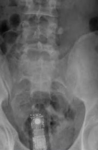X-ray
