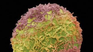 Prostate cancer cell