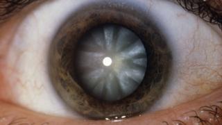 Eye with cataract