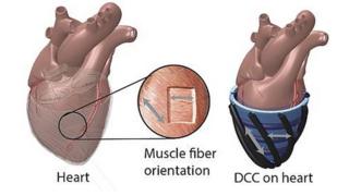 Picture of a robotic sleeve that envelopes the heart