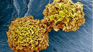 Células del cáncer de mama.