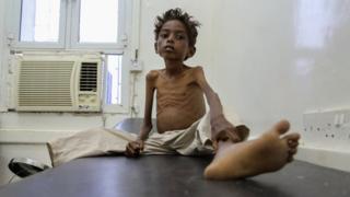 Umwana w'imyaka itanu Mohannad Ali yicaye mu bitaro muri Yemeni mu kwezi kwa 12. Mubyara we w'imyaka ine, yishwe n'inzara.