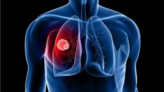 Lung cancer