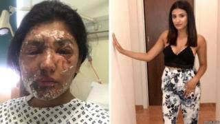 Resham Khan was left with burns on her face, arms, legs and shoulder after having acid thrown at her