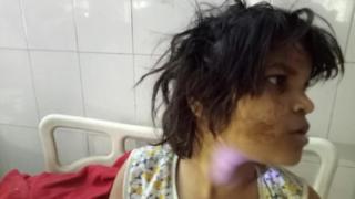 মেয়েটির স্বাস্থ্যের উন্নতি হচ্ছে বলে ডাক্তাররা বলছেন।