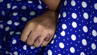 In this photograph taken on 10 October 2014 burn marks are seen on the hand of Indian acid attack survivor Reshma as she rests in her home at a slum in the eastern suburbs of Mumbai.