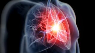 Anti-inflammatory drug 'cuts heart attack risk' _97571726_attack_spl