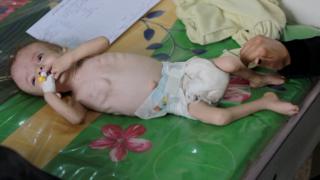 Picture showing child suffering with cholera