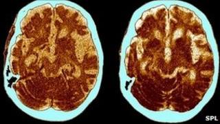 Brain scan of a person with Alzheimer's