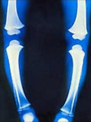 Coloured X-Ray of the legs of a child with rickets