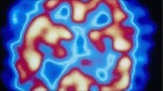 Schizophrenia brain scan