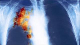 Lung cancer x-ray