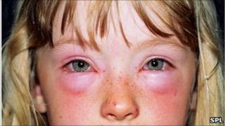 child having allergic reaction