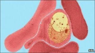 Blood cells infected with malaria
