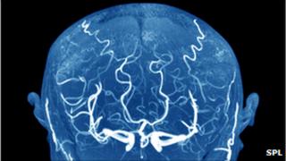 Blood vessels in the brain