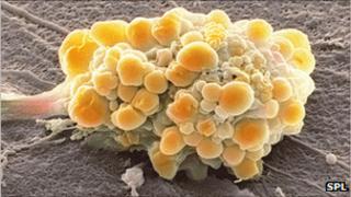 Brain tumour
