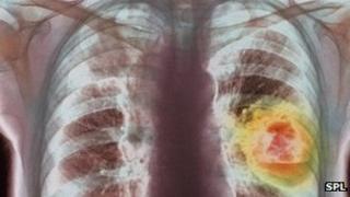 Lung cancer