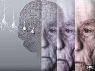 How dementia progresses with time