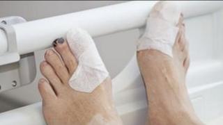 Feet of a person with diabetes