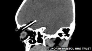 CT Head scan image showing the pencil